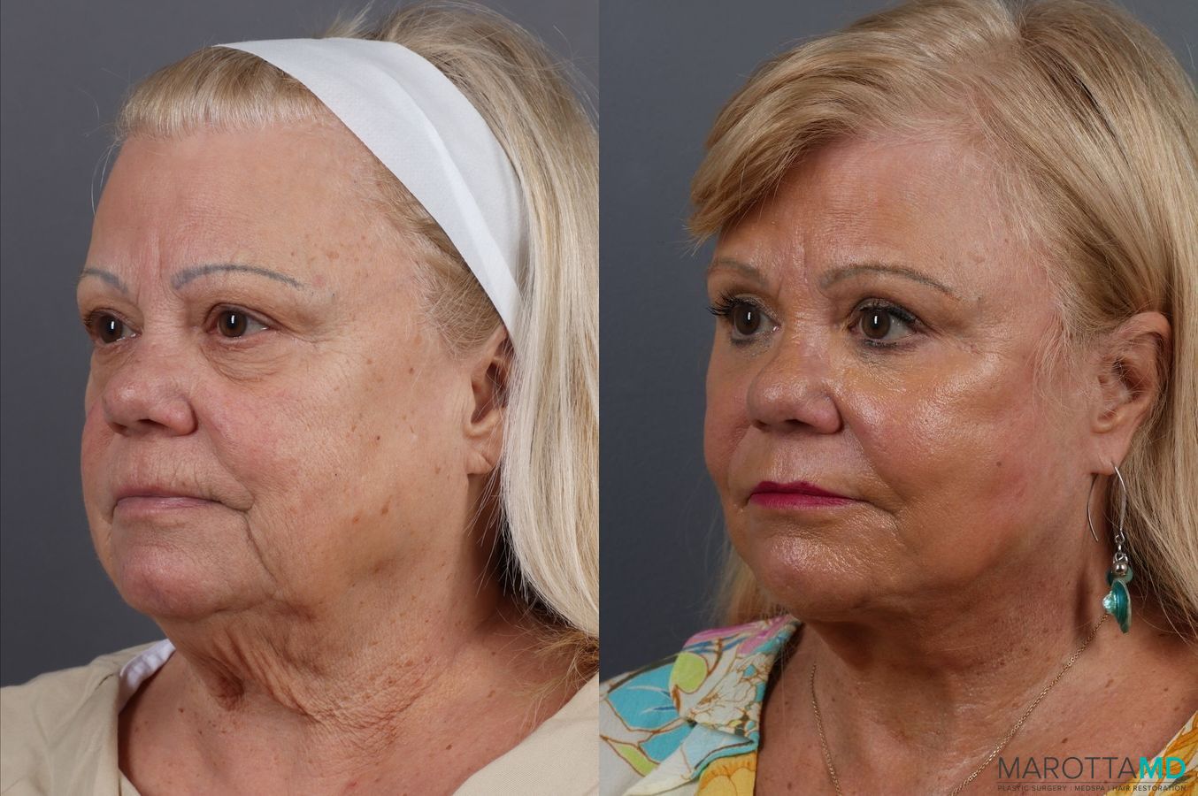 Before and after Laser Skin Resurfacing - Face case 7312 - Angle 4