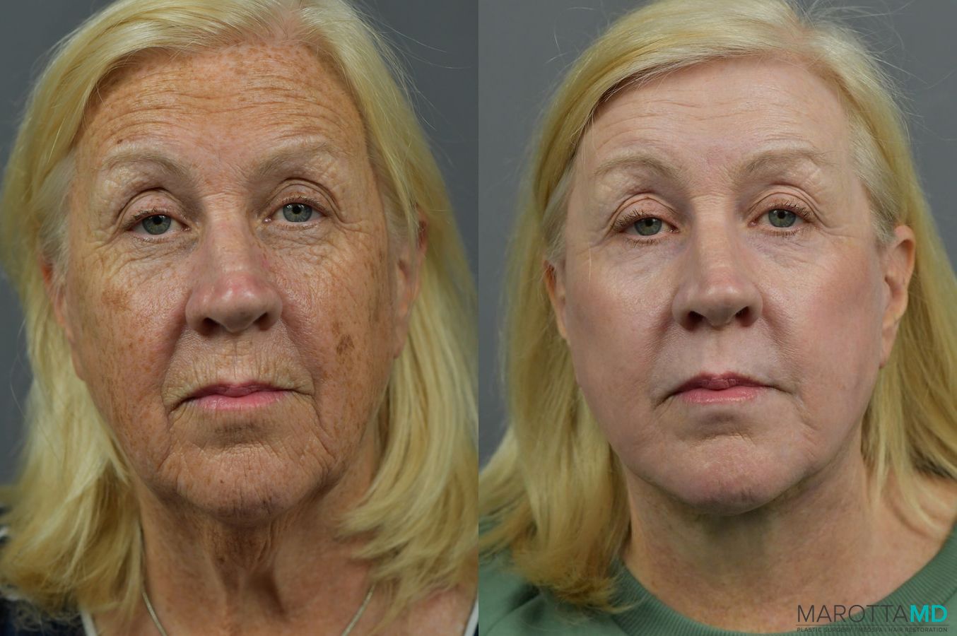 Before and after Laser Skin Resurfacing - Face case 7021