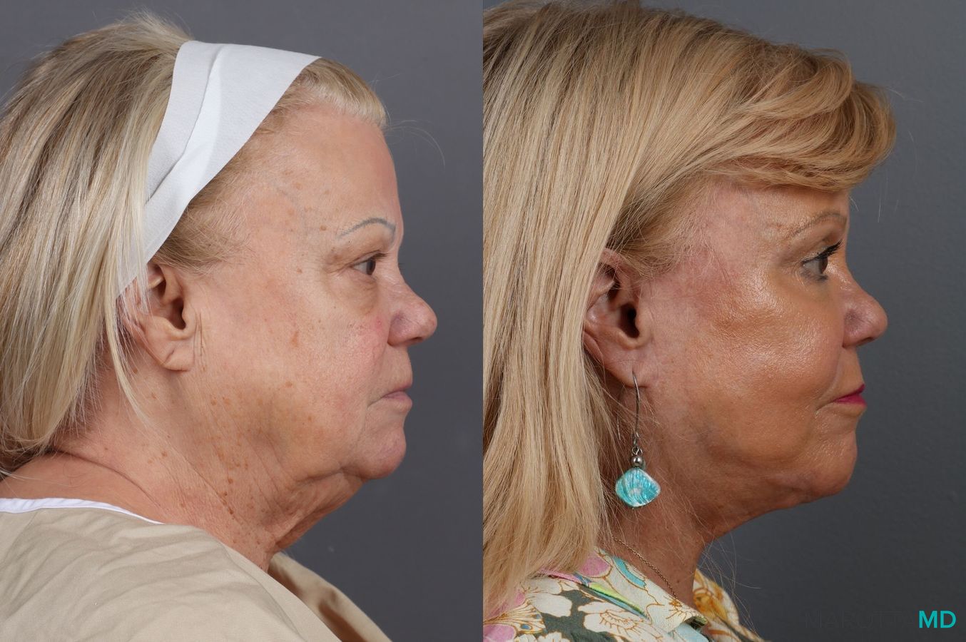 Before and after Laser Skin Resurfacing - Face case 7312 - Angle 3