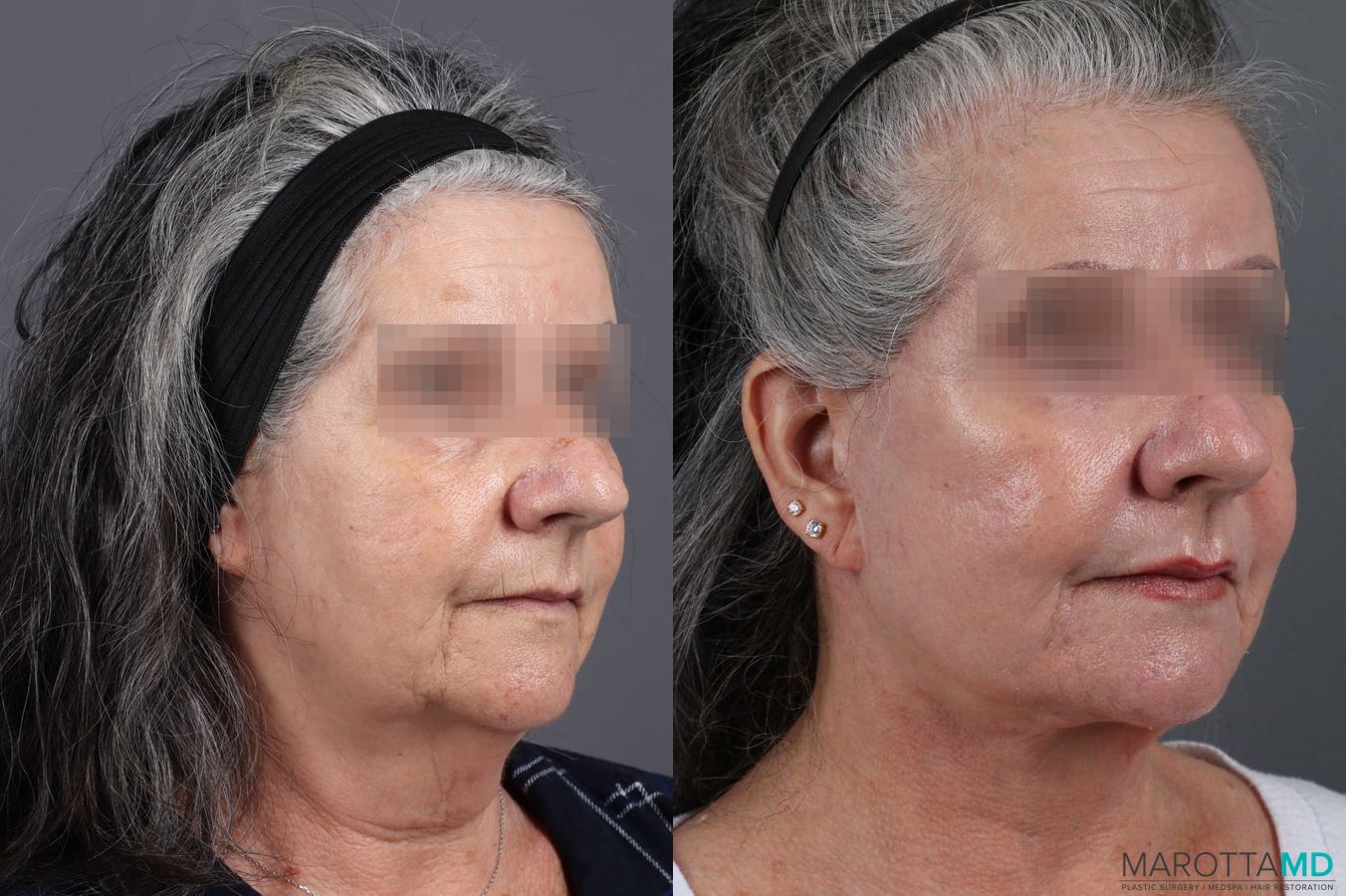 Before and after Laser Skin Resurfacing - Face case 7310 - Angle 3