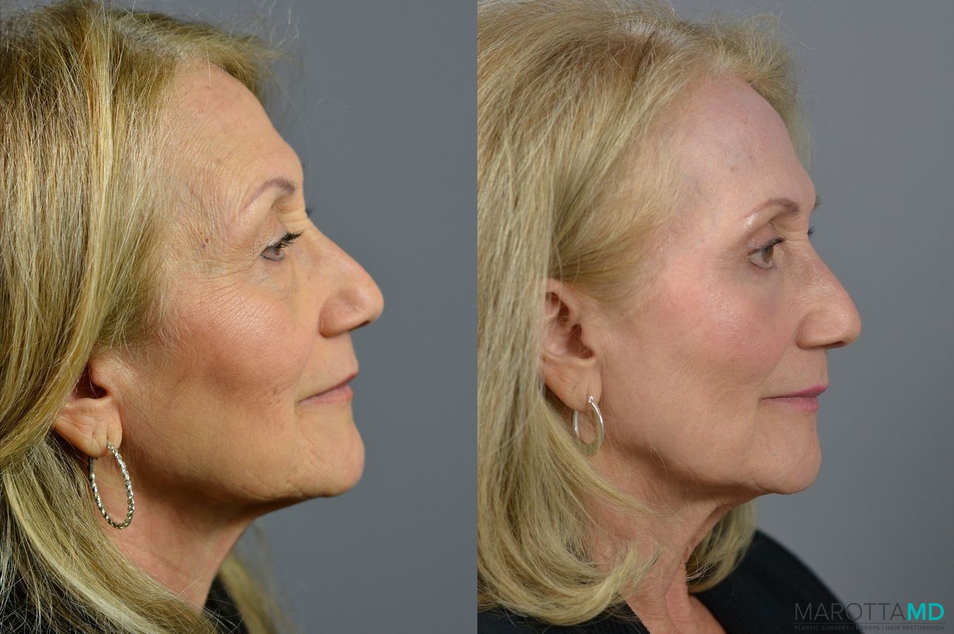 Before and after Laser Skin Resurfacing - Face case 6992 - Angle 5