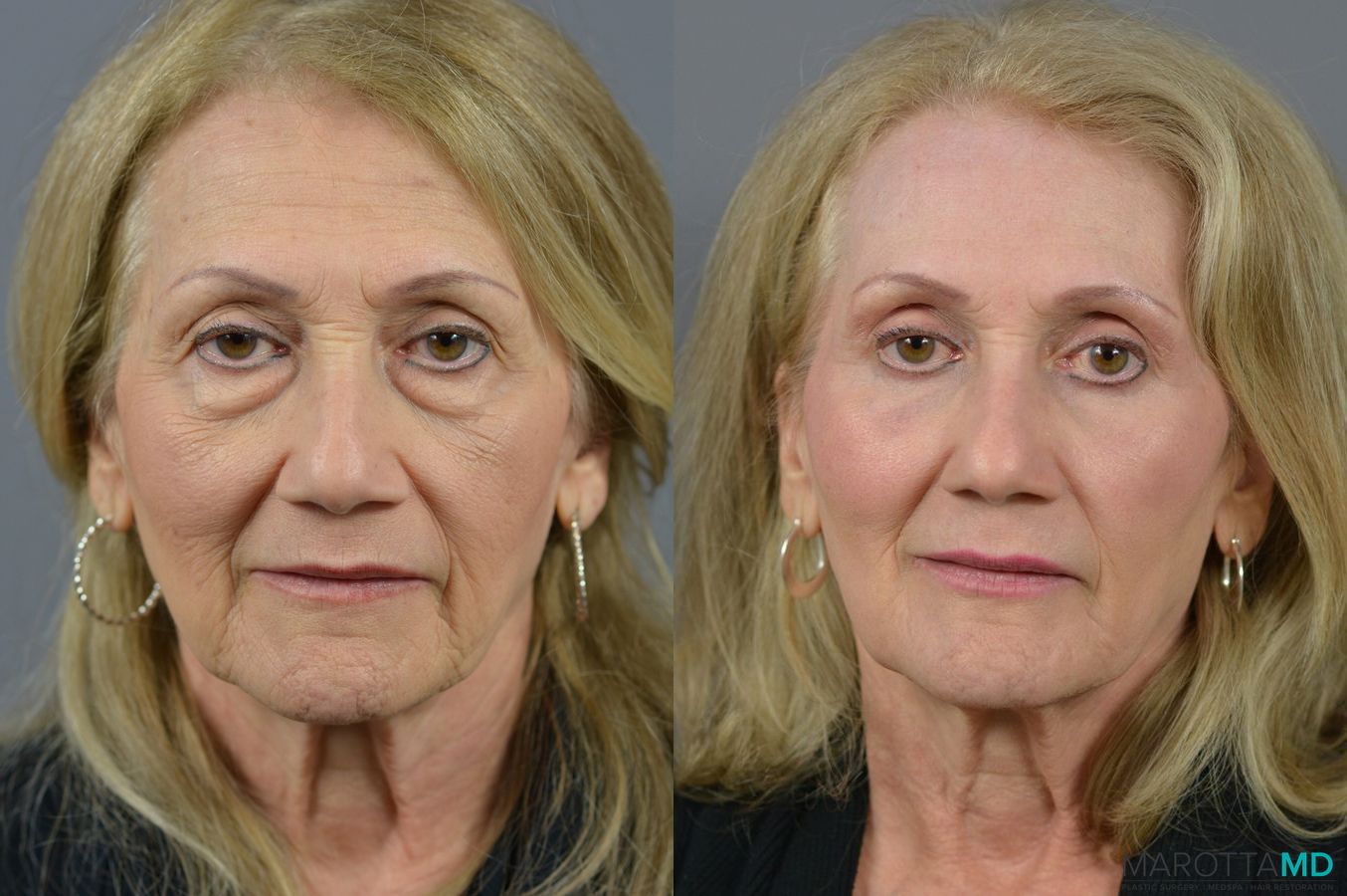 Before and after Laser Skin Resurfacing - Face case 6992
