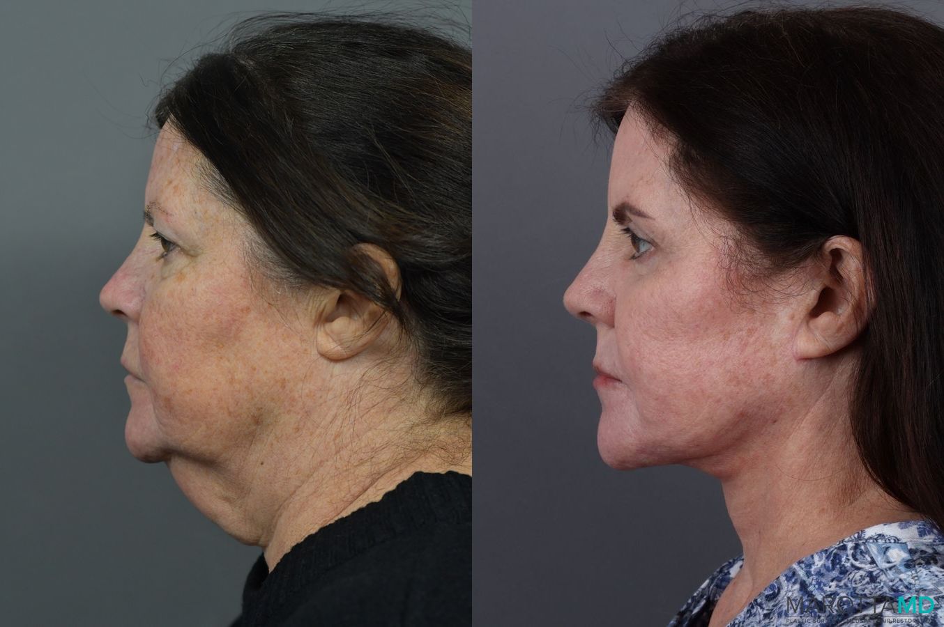 Before and after Laser Skin Resurfacing - Face case 7010 - Angle 5