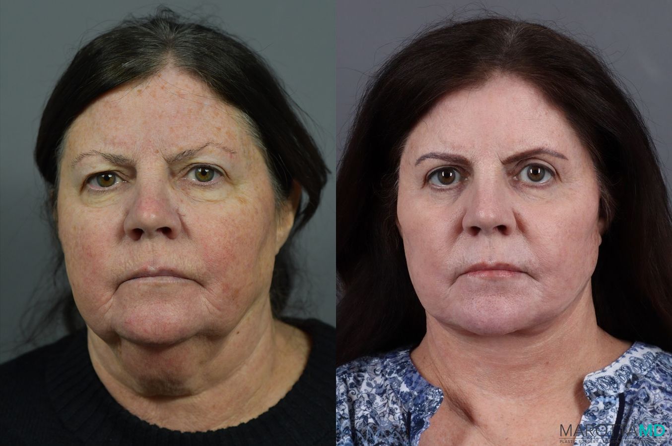 Before and after Laser Skin Resurfacing - Face case 7010