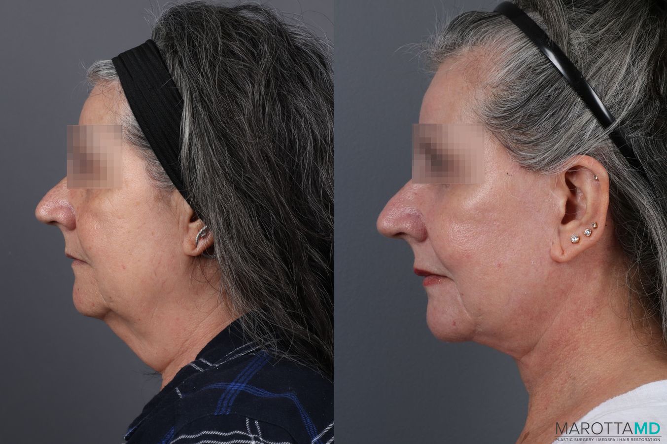 Before and after Laser Skin Resurfacing - Face case 7310 - Angle 4