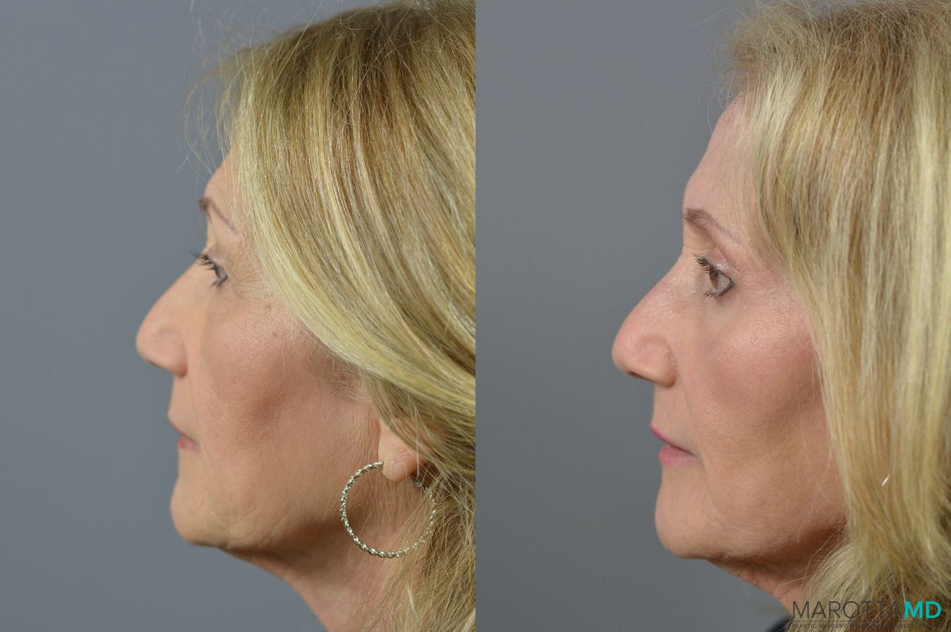 Before and after Laser Skin Resurfacing - Face case 6992 - Angle 3