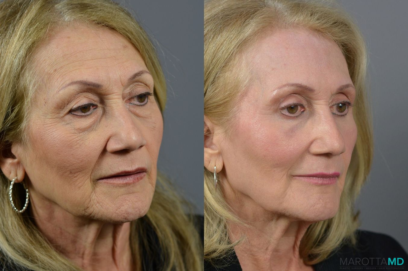 Before and after Laser Skin Resurfacing - Face case 6992 - Angle 4