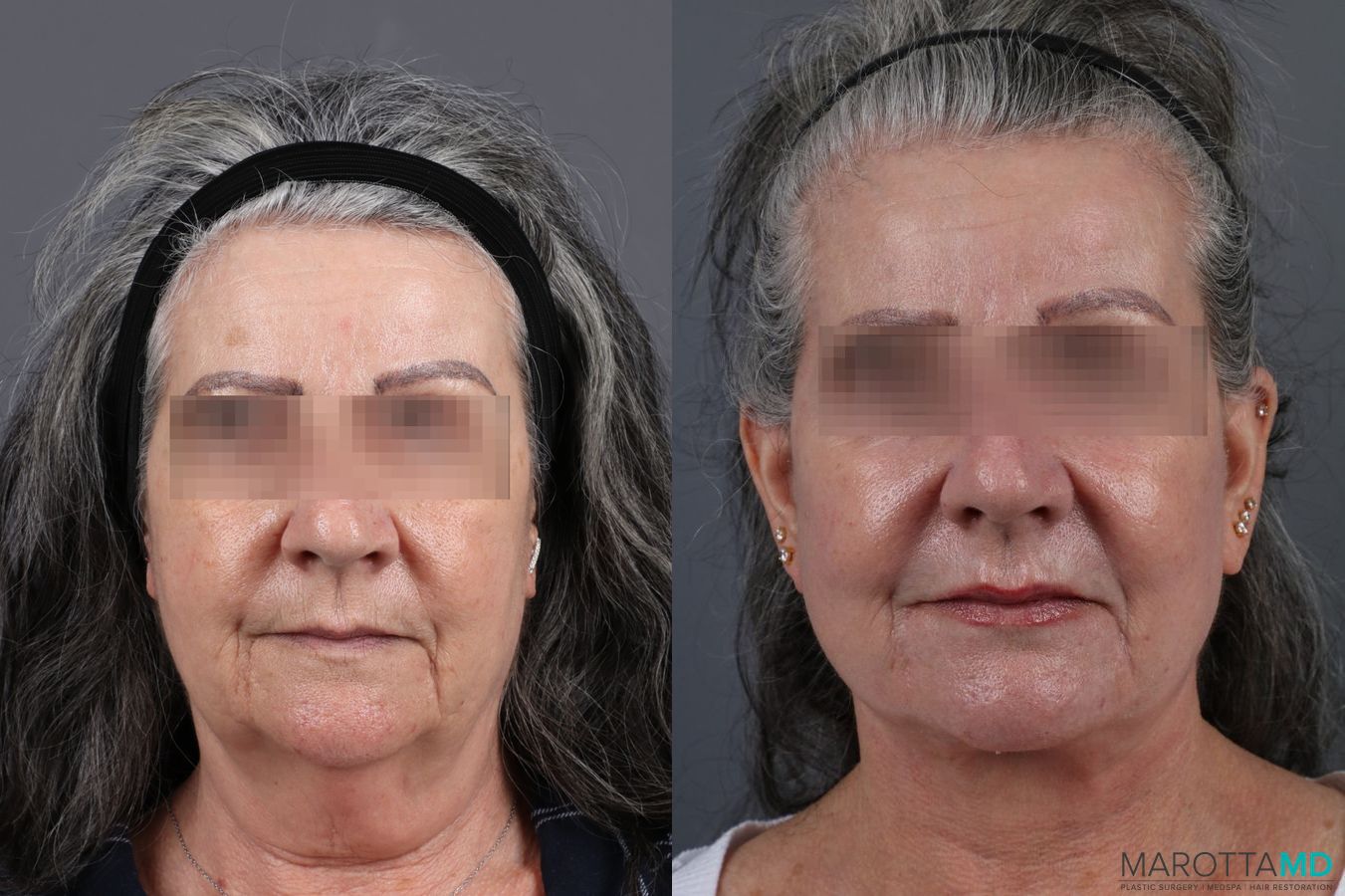 Before and after Laser Skin Resurfacing - Face case 7310