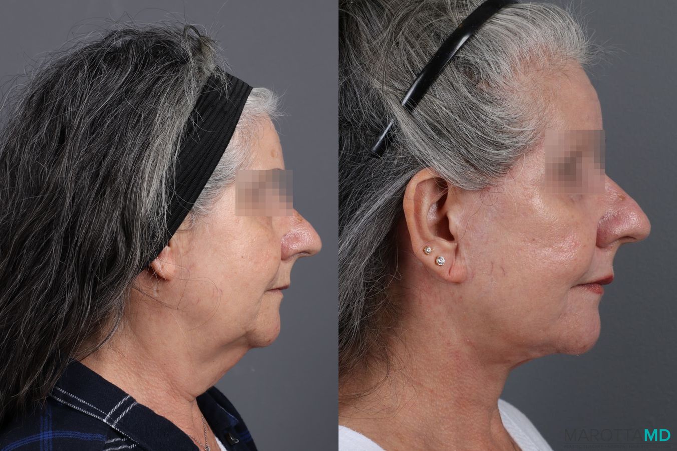 Before and after Laser Skin Resurfacing - Face case 7310 - Angle 5