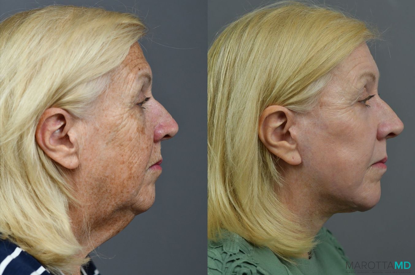 Before and after Laser Skin Resurfacing - Face case 7021 - Angle 5