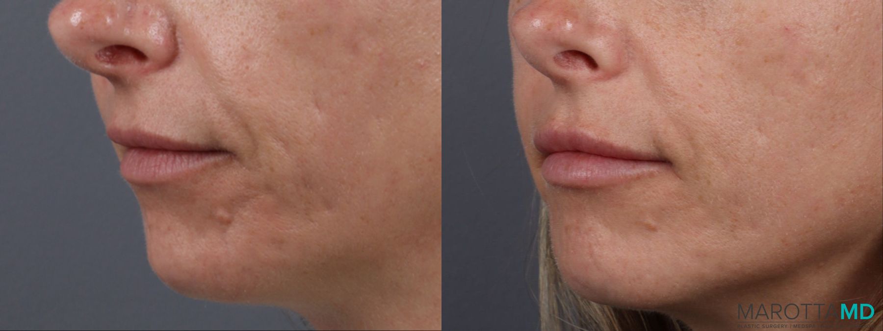 Before and after Lip Filler case 14124 - Angle 4