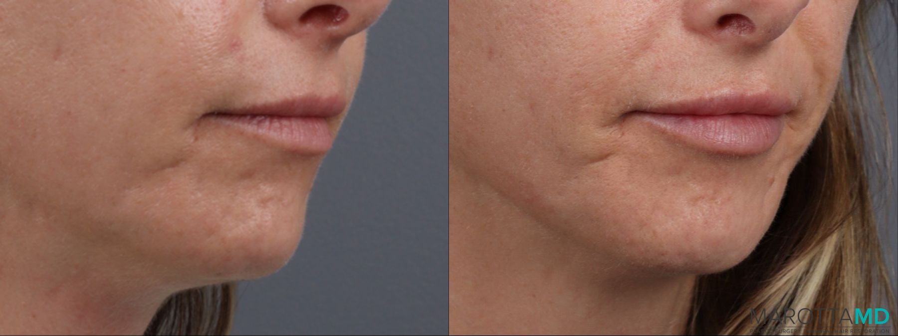 Before and after Lip Filler case 14124 - Angle 2