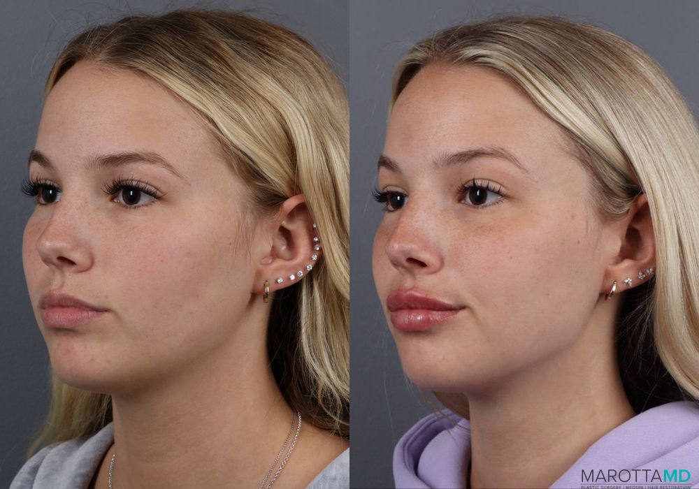 Lip Filler - Thumbnail 3