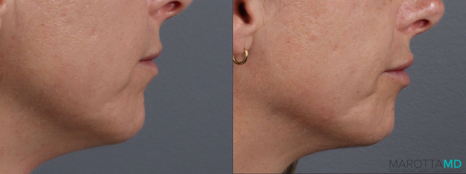 Before and after Lip Filler case 14124 - Angle 3