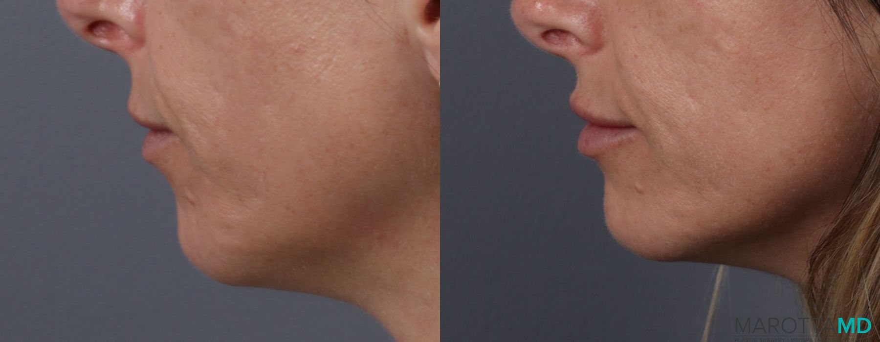 Lip Filler - Thumbnail 5