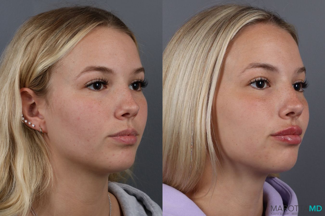 Before and after Lip Filler case 14113 - Angle 2
