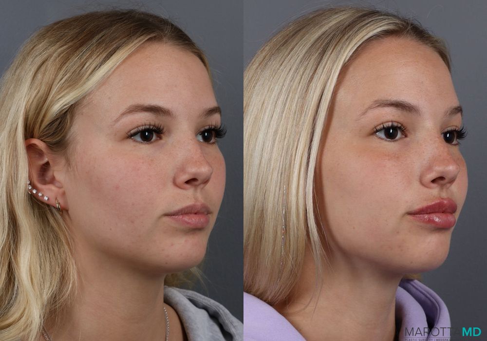 Lip Filler - Thumbnail 2