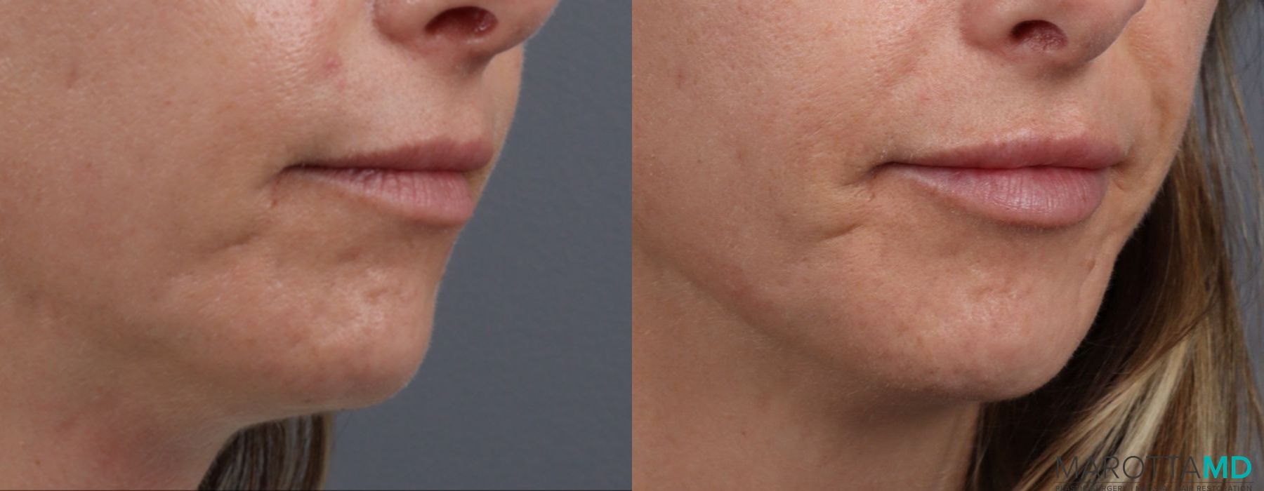 Lip Filler - Thumbnail 2