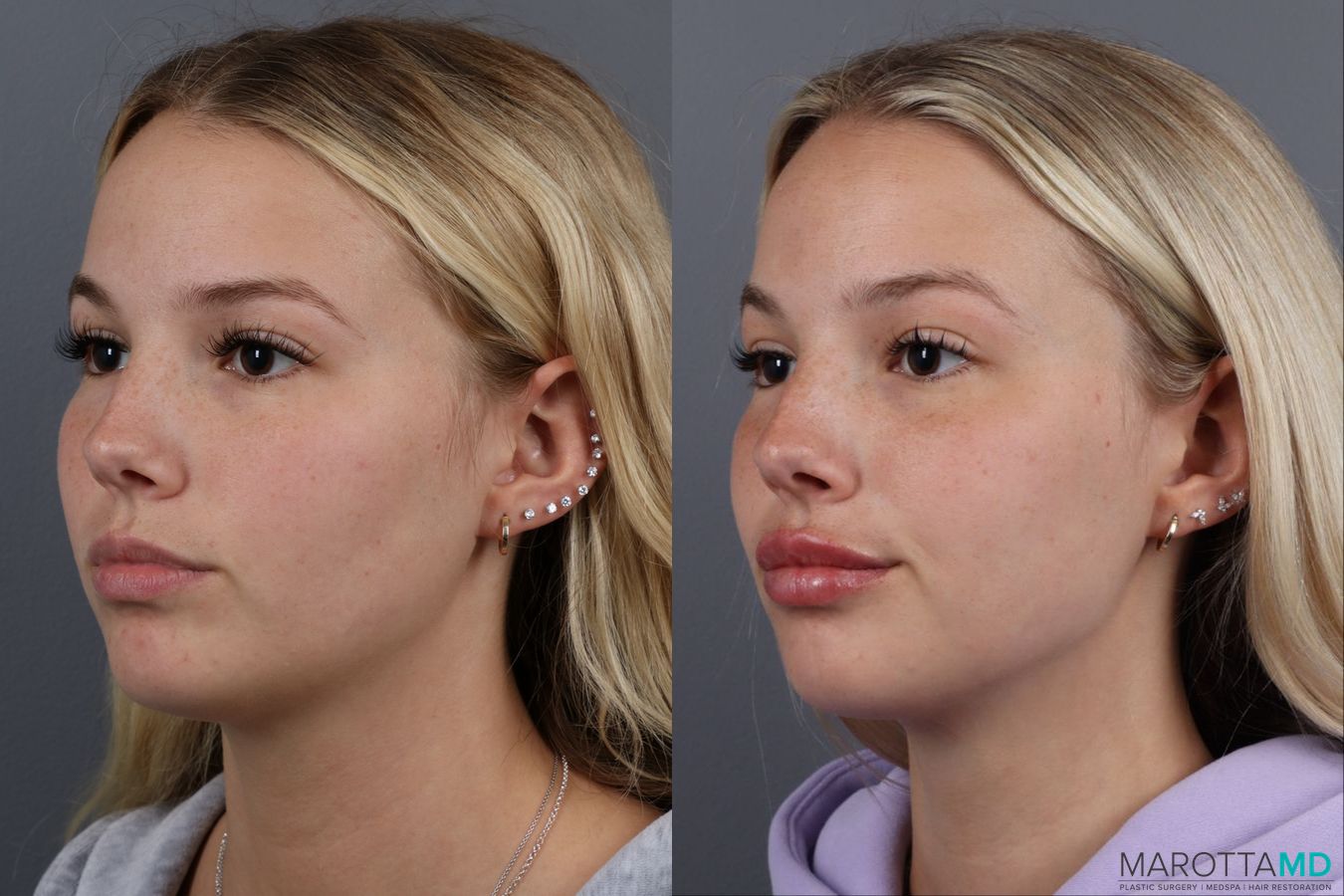 Before and after Lip Filler case 14113 - Angle 3