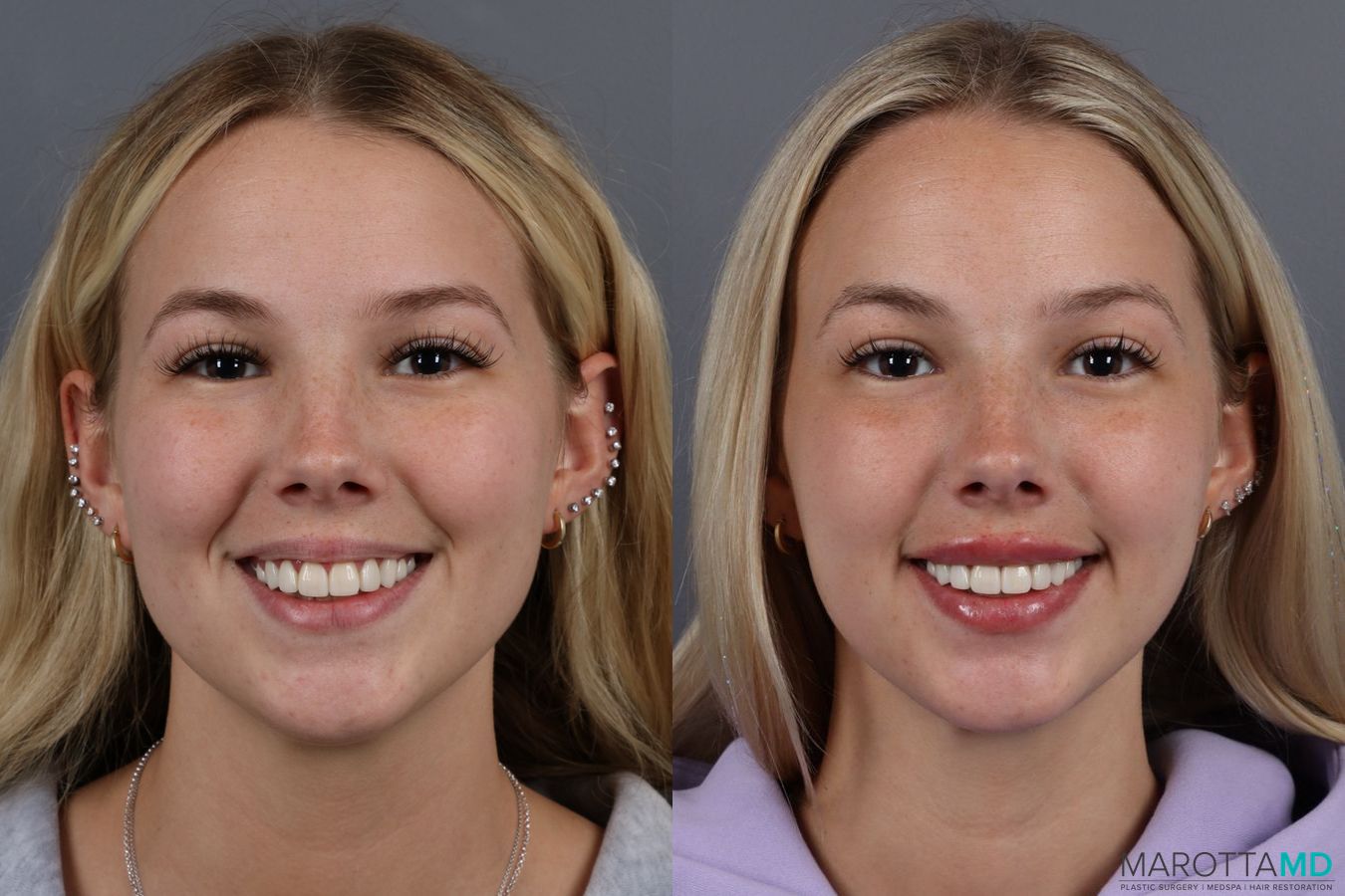 Before and after Lip Filler case 14113 - Angle 4