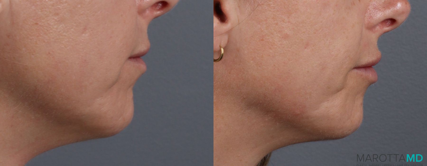 Lip Filler - Thumbnail 3