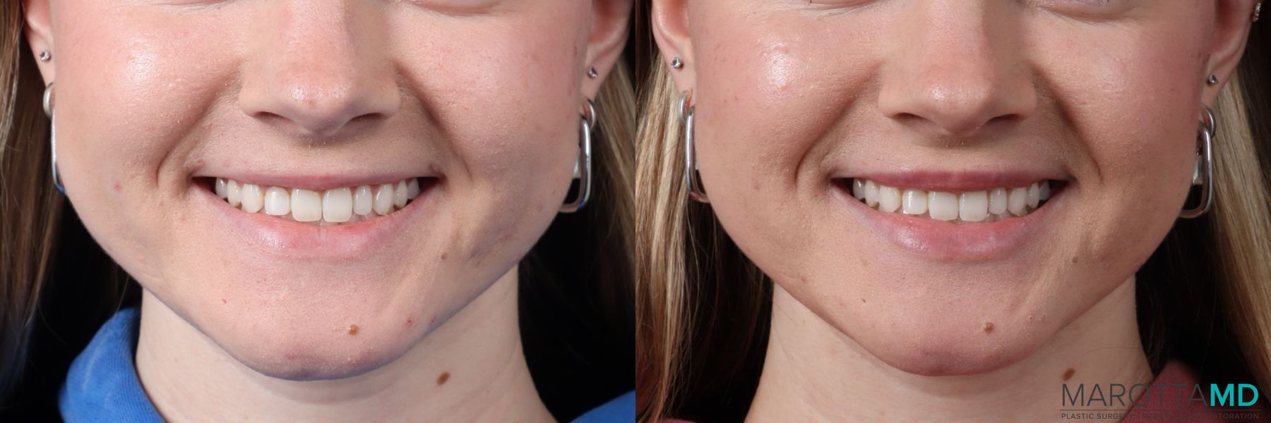 Before and after Botox - Lip Flip case 41874