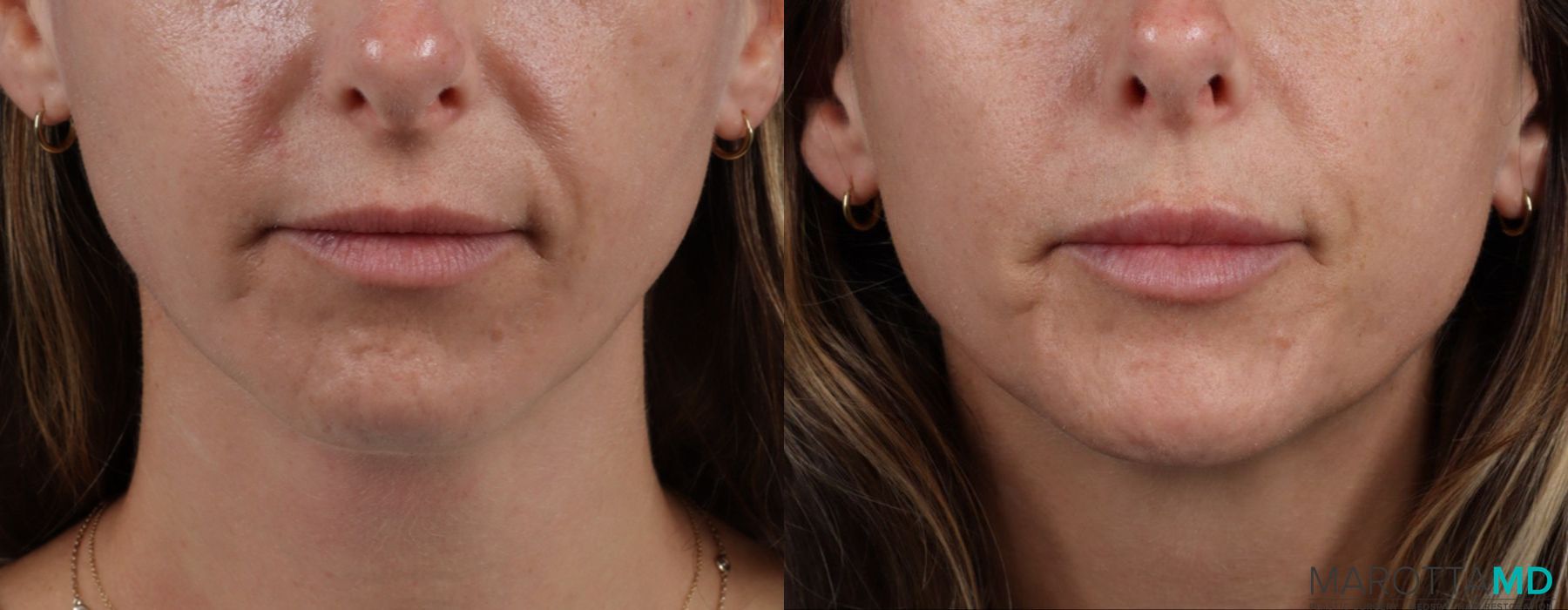 Lip Filler - Case 220