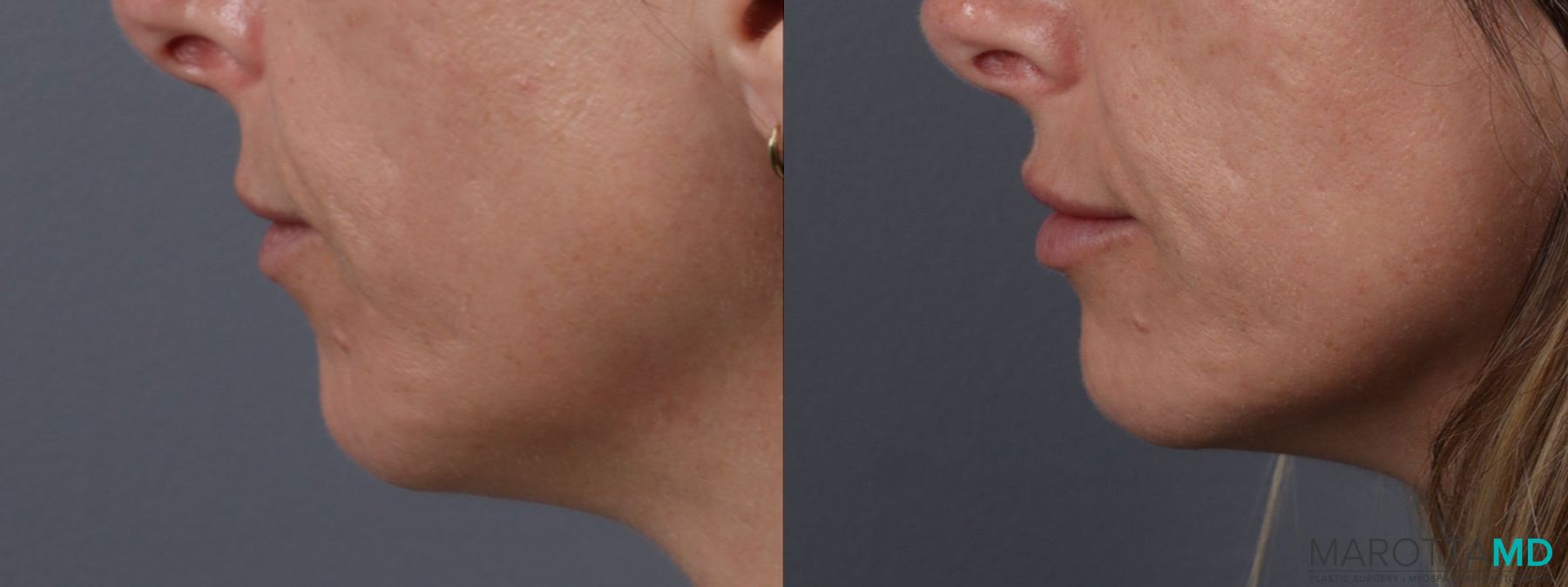Before and after Lip Filler case 14124 - Angle 5