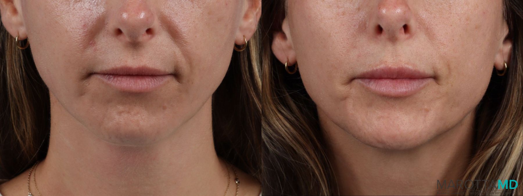 Before and after Lip Filler case 14124