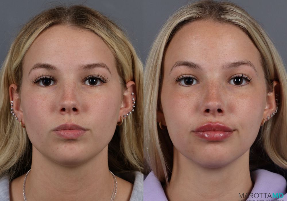 Lip Filler - Case 219