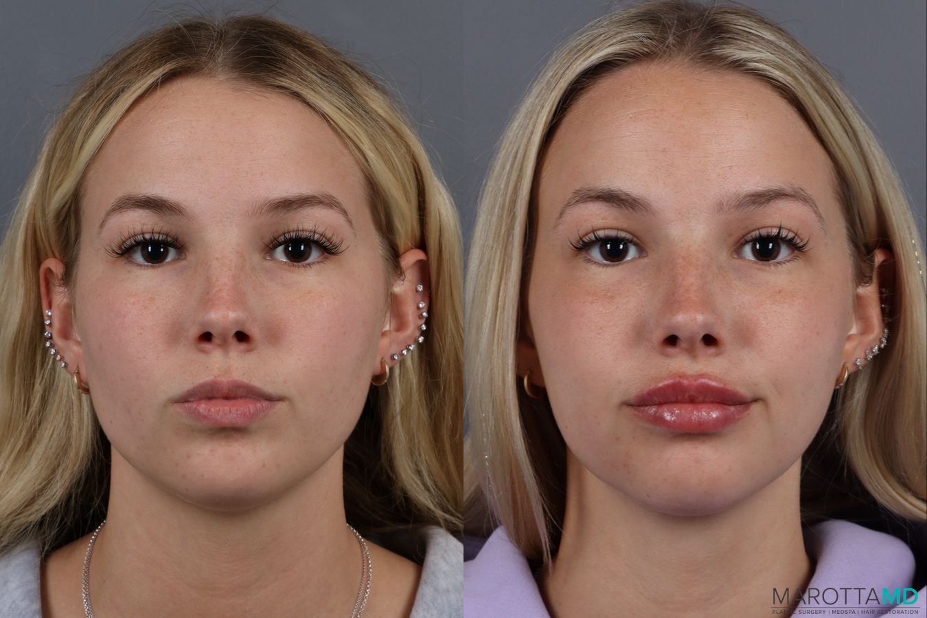 Before and after Lip Filler case 14113
