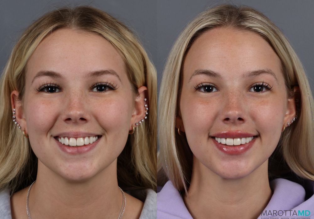 Lip Filler - Thumbnail 4