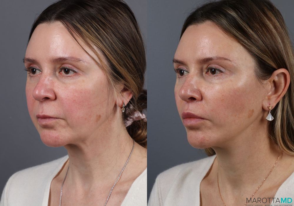 Lip Lift - Thumbnail 5