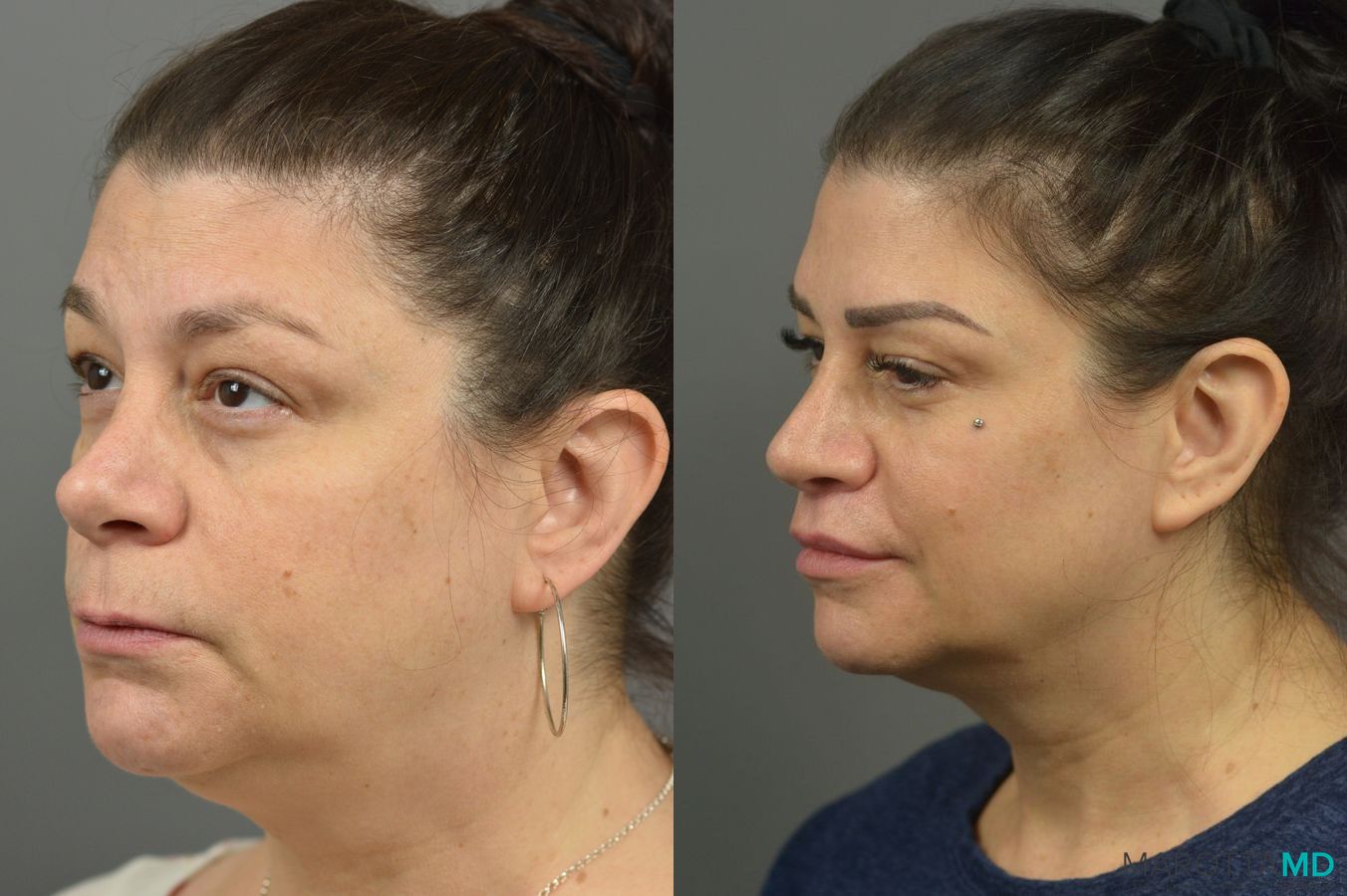 Before and after Lip Lift case 7017 - Angle 2