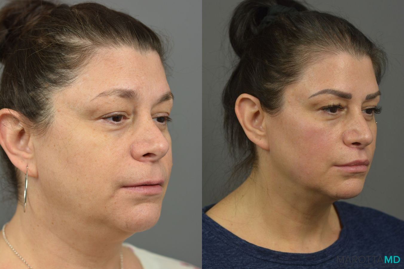 Before and after Lip Lift case 7017 - Angle 3