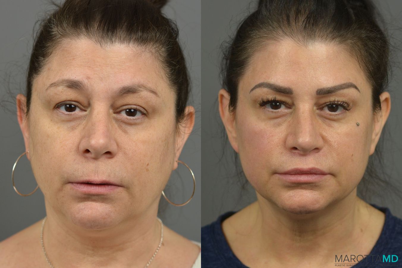 Before and after Lip Lift case 7017