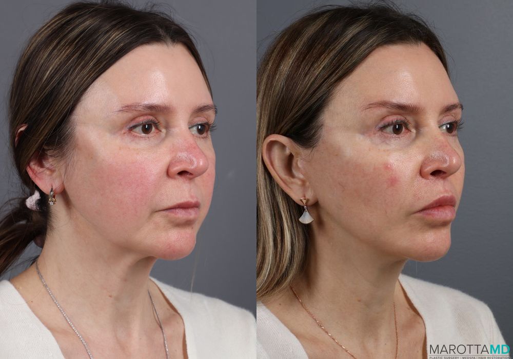 Lip Lift - Thumbnail 3