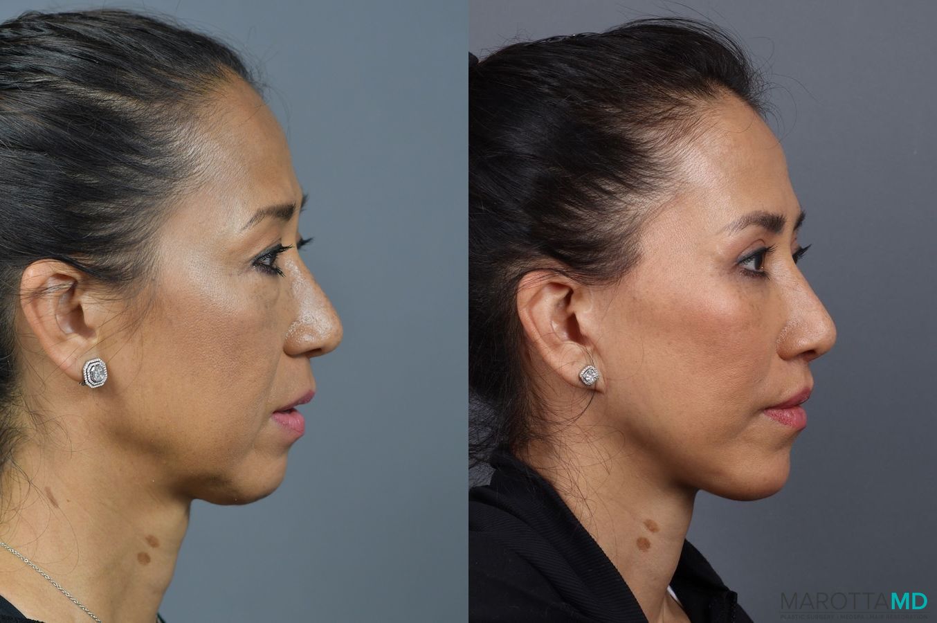 Before and after Lip Lift case 7008 - Angle 3