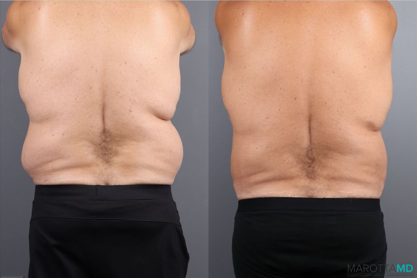 Before and after Liposuction case 41928