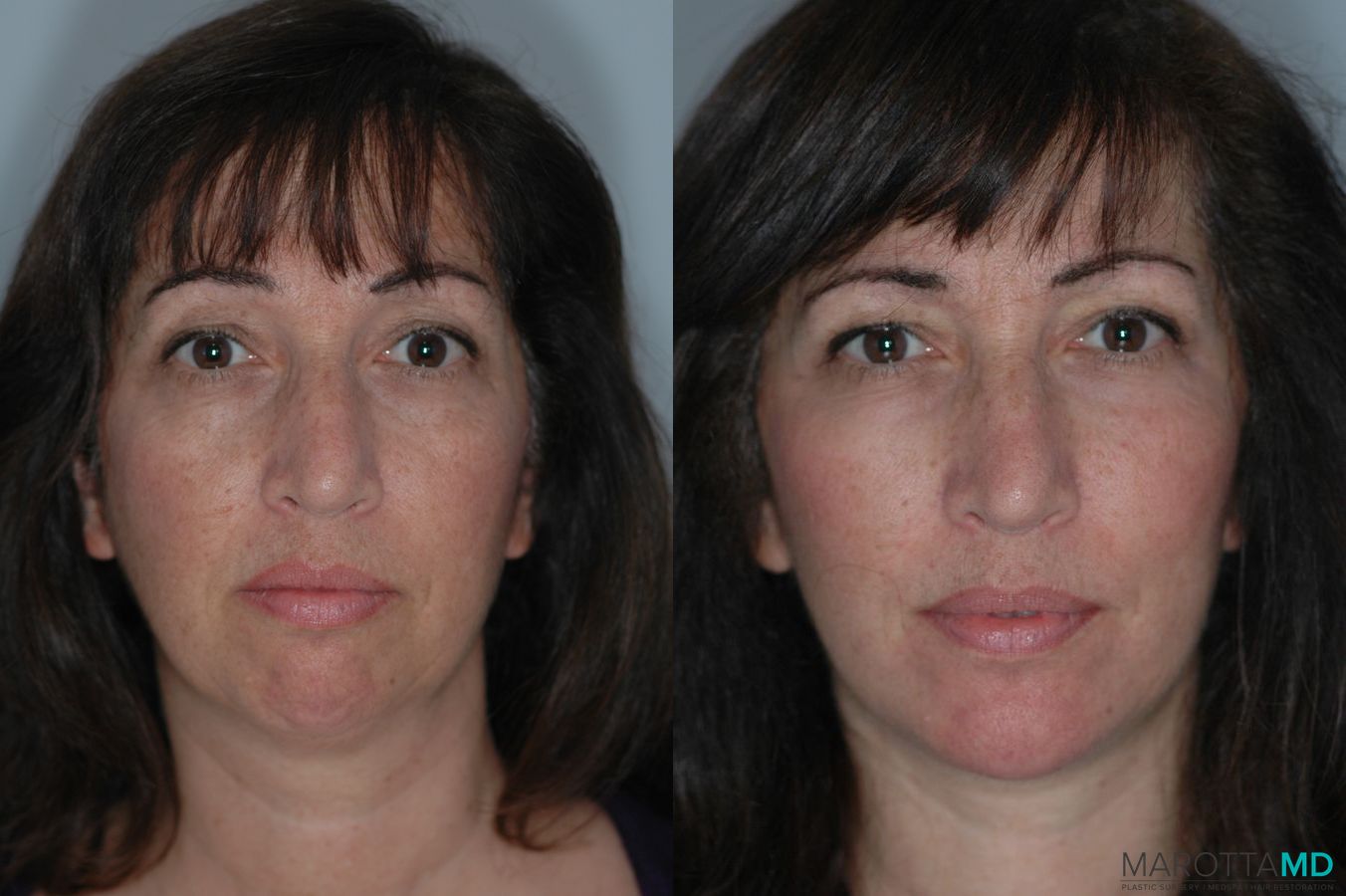 Before and after Liposuction of the Neck case 7020