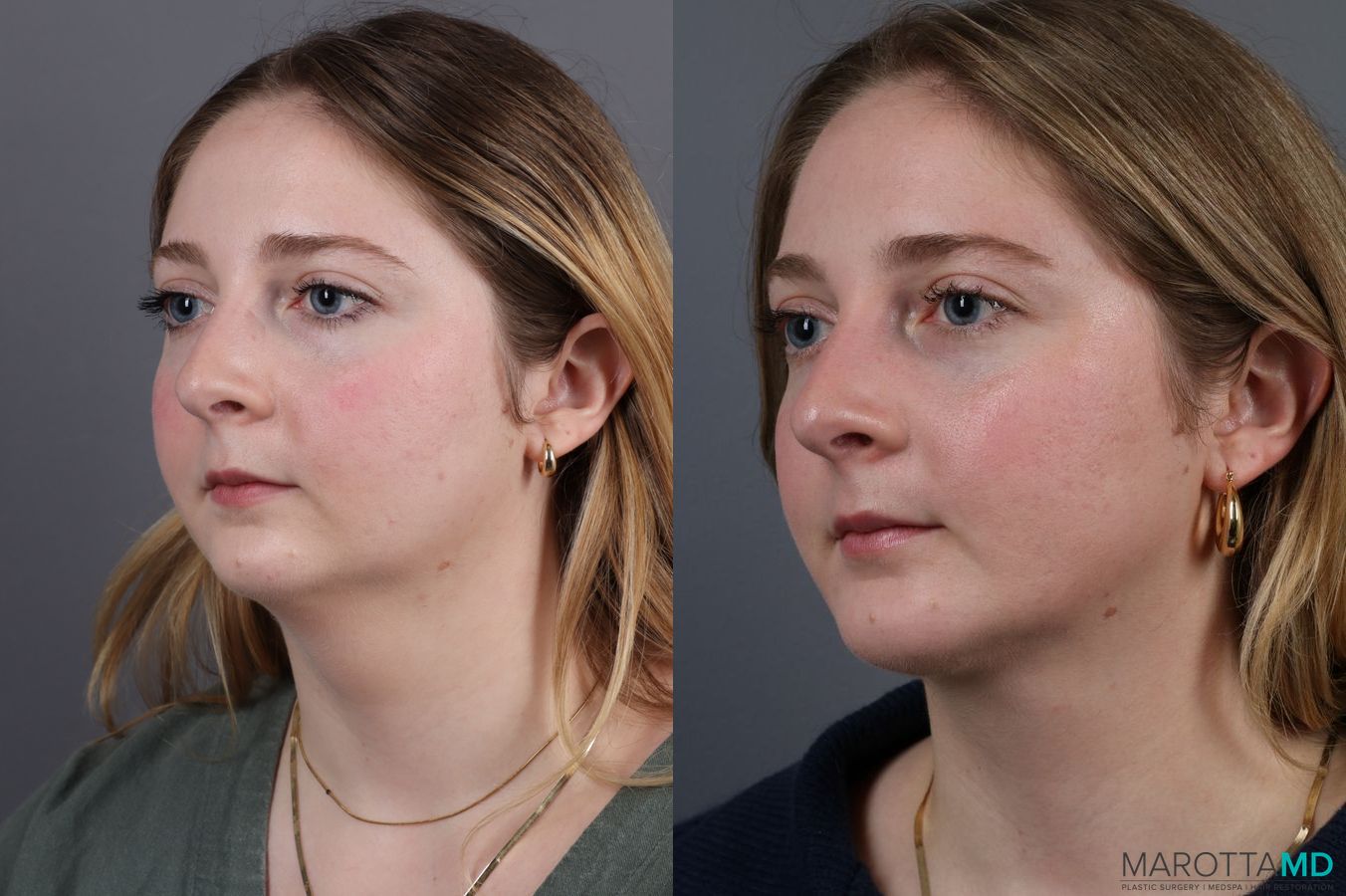 Before and after Liposuction of the Neck case 7031 - Angle 2