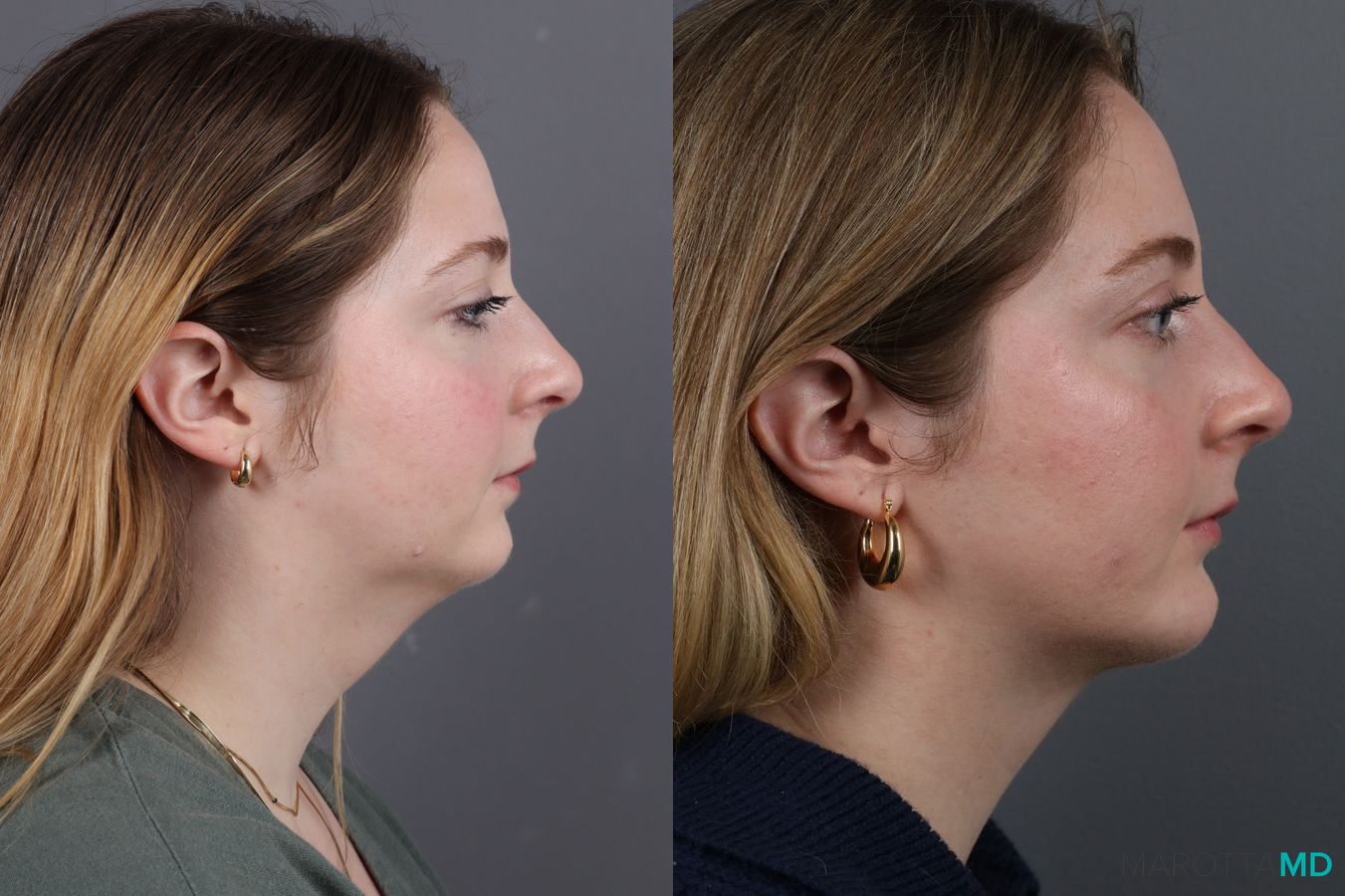 Before and after Liposuction of the Neck case 7031 - Angle 4