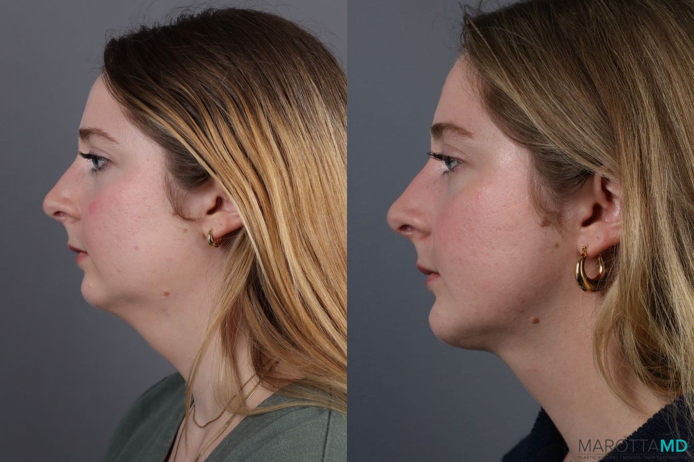 Before and after Liposuction of the Neck case 7031 - Angle 3