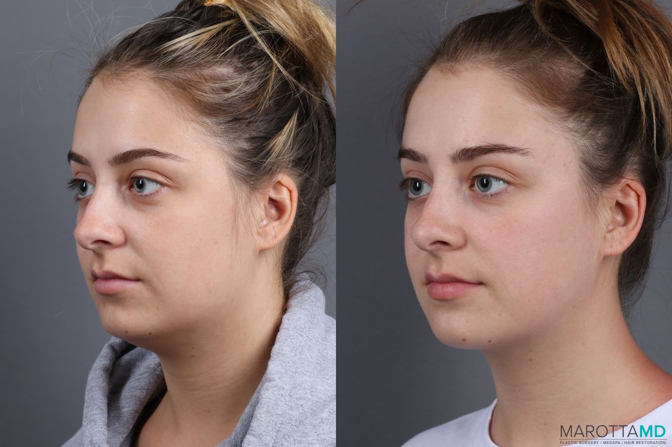 Before and after Liposuction of the Neck case 7051 - Angle 4