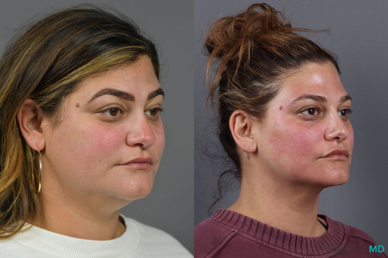 Before and after Liposuction of the Neck case 6991 - Angle 4