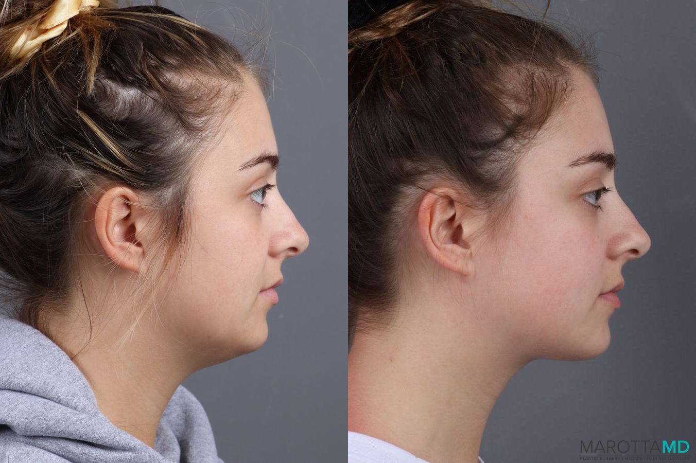 Before and after Liposuction of the Neck case 7051 - Angle 2