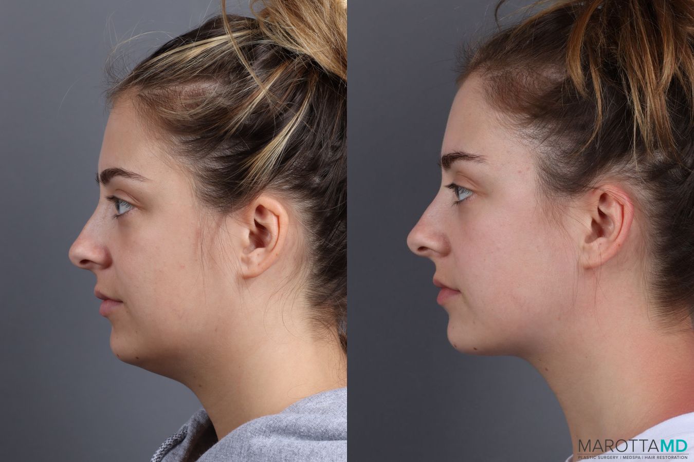 Before and after Liposuction of the Neck case 7051 - Angle 3