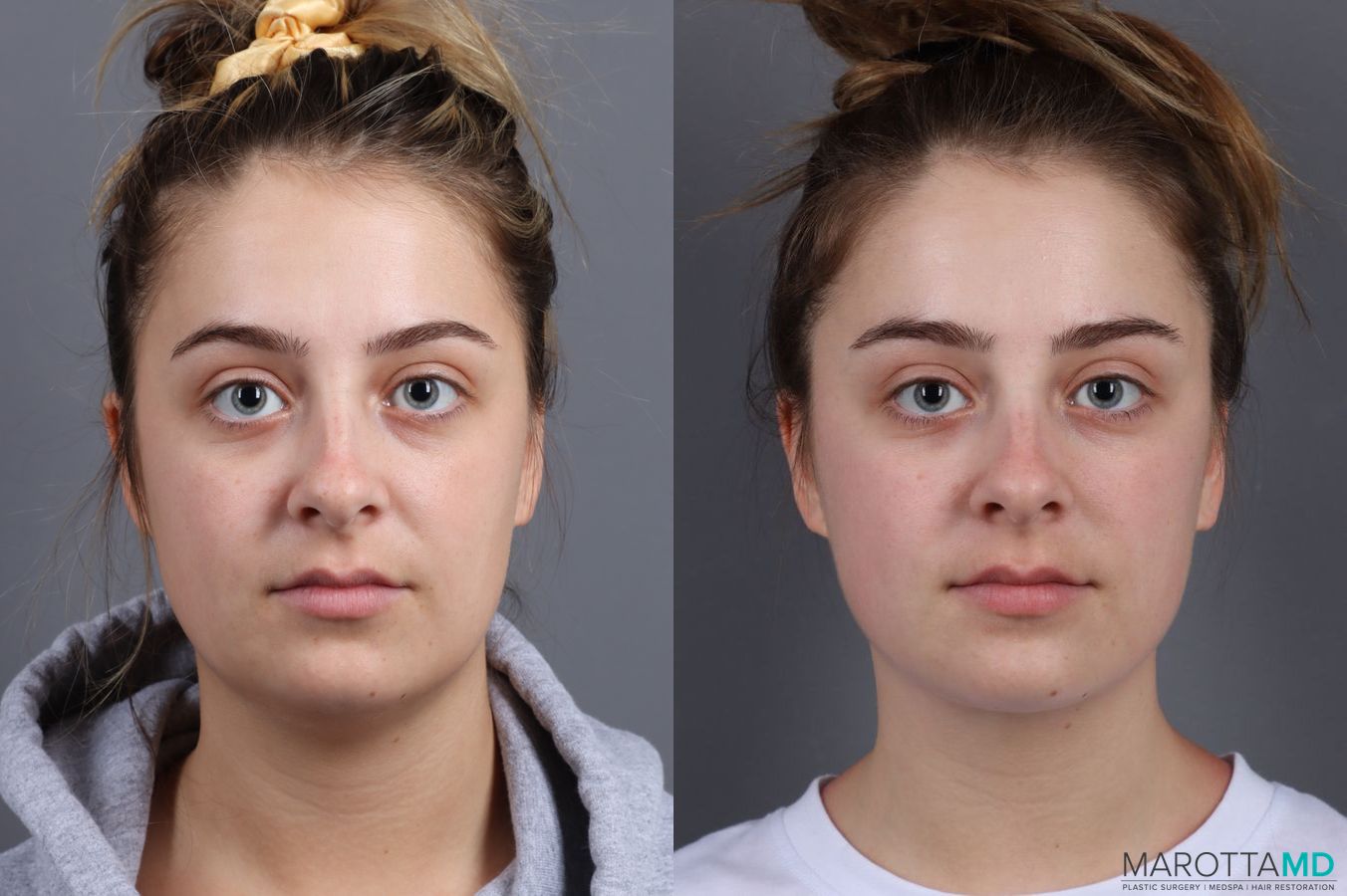 Before and after Liposuction of the Neck case 7051