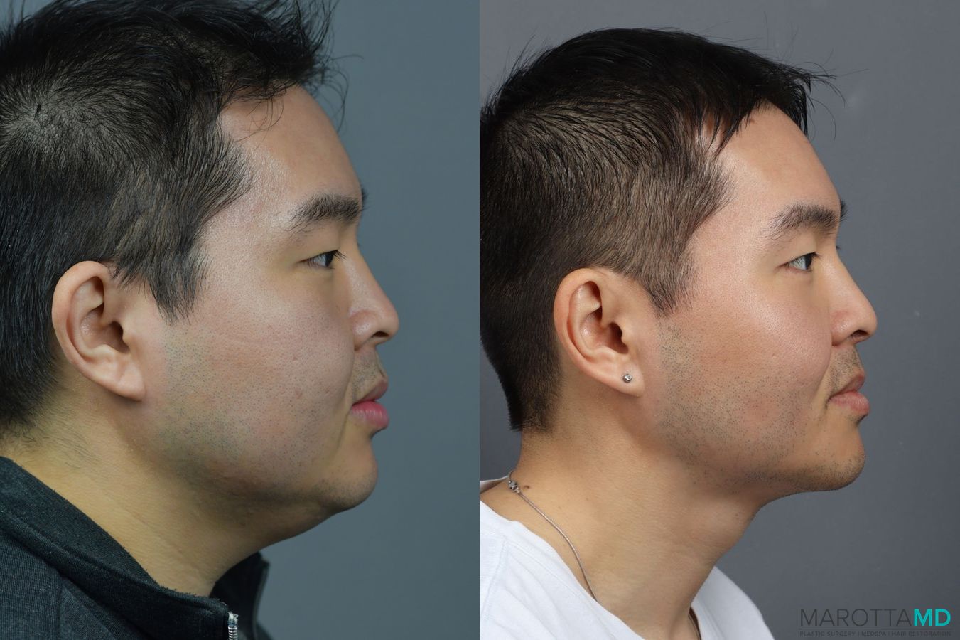 Before and after Liposuction of the Neck case 7041 - Angle 2