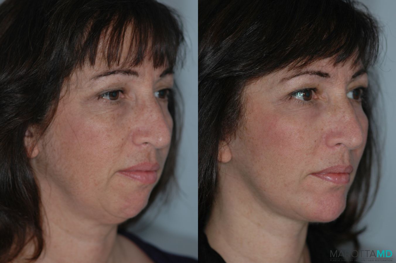 Before and after Liposuction of the Neck case 7020 - Angle 2